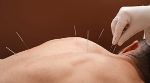 man receiving acupuncture program in Springfield OH